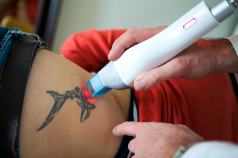 Tattoo Removal Laser | Alamy Stock Photo by AMELIE-BENOIST/BSIP SA