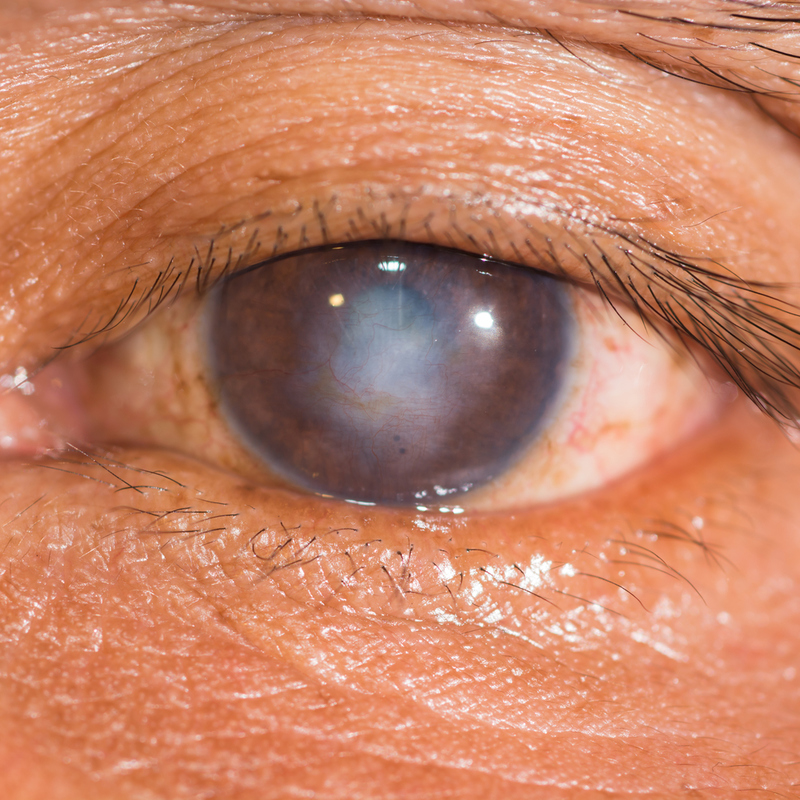 La cicatriz de un globo ocular | Shutterstock