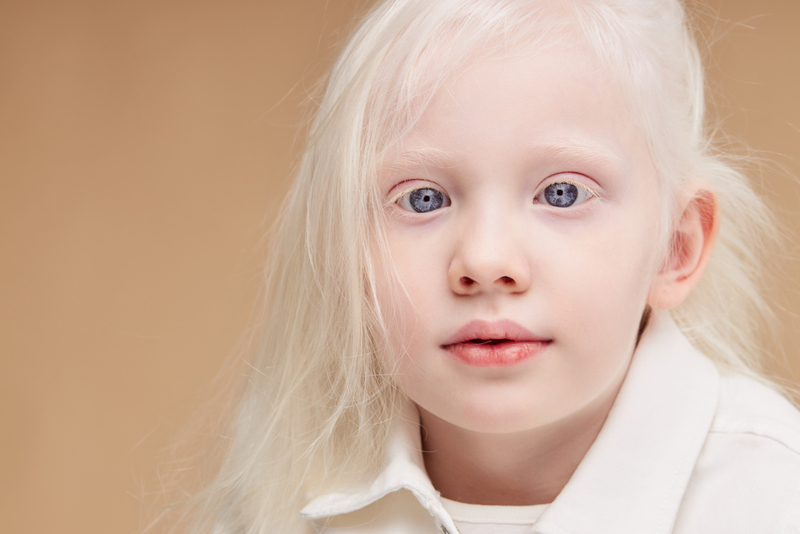 Okulärer Albinismus bedeutet mehr als nur eine Reduzierung der Pigmentierung | Shutterstock